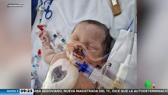 Un bebé con medio corazón sobrevive, contra todo pronóstico, tras una complicada intervención Un bebé con medio corazón sobrevive, contra todo pronóstico, tras una complicada intervención