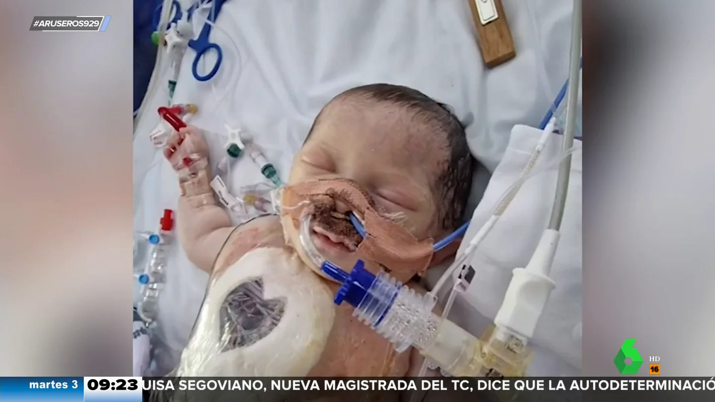 Un bebé con medio corazón sobrevive, contra todo pronóstico, tras una complicada intervención Un bebé con medio corazón sobrevive, contra todo pronóstico, tras una complicada intervención