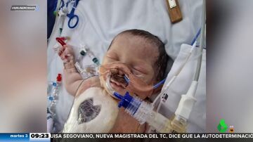 Un bebé con medio corazón sobrevive, contra todo pronóstico, tras una complicada intervención