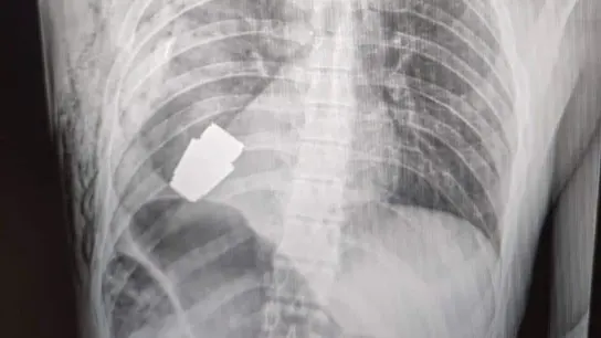 Imagen que muestra la radiografía del soldado con la granada aún en el cuerpo. Imagen que muestra la radiografía del soldado con la granada aún en el cuerpo.
