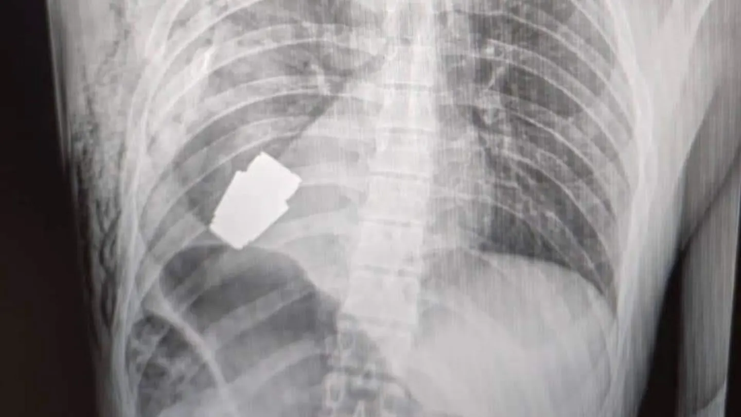 Imagen que muestra la radiografía del soldado con la granada aún en el cuerpo. Imagen que muestra la radiografía del soldado con la granada aún en el cuerpo.