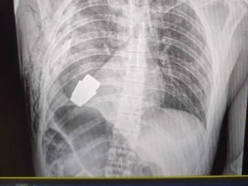 They operate on a Ukrainian soldier to remove a grenade from his body: “It could detonate at any time”
