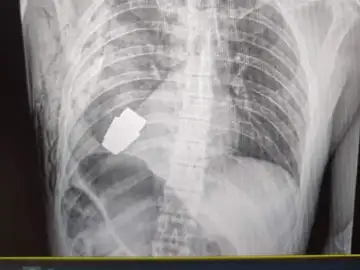 Imagen que muestra la radiografía del soldado con la granada aún en el cuerpo.