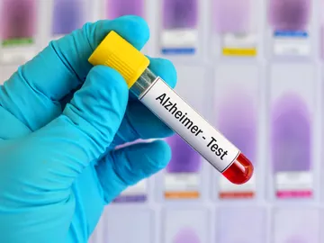 Alzheimer marcador sanguíneo Alzheimer marcador sanguíneo