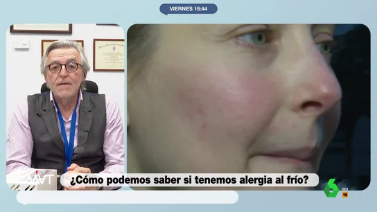 ¿Tienes alergia al frío? Estos son los síntomas leves y los más graves ¿Tienes alergia al frío? Estos son los síntomas leves y los más graves