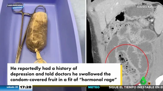 Se come un plátano con un preservativo y acaba en urgencias Se come un plátano con un preservativo y acaba en urgencias