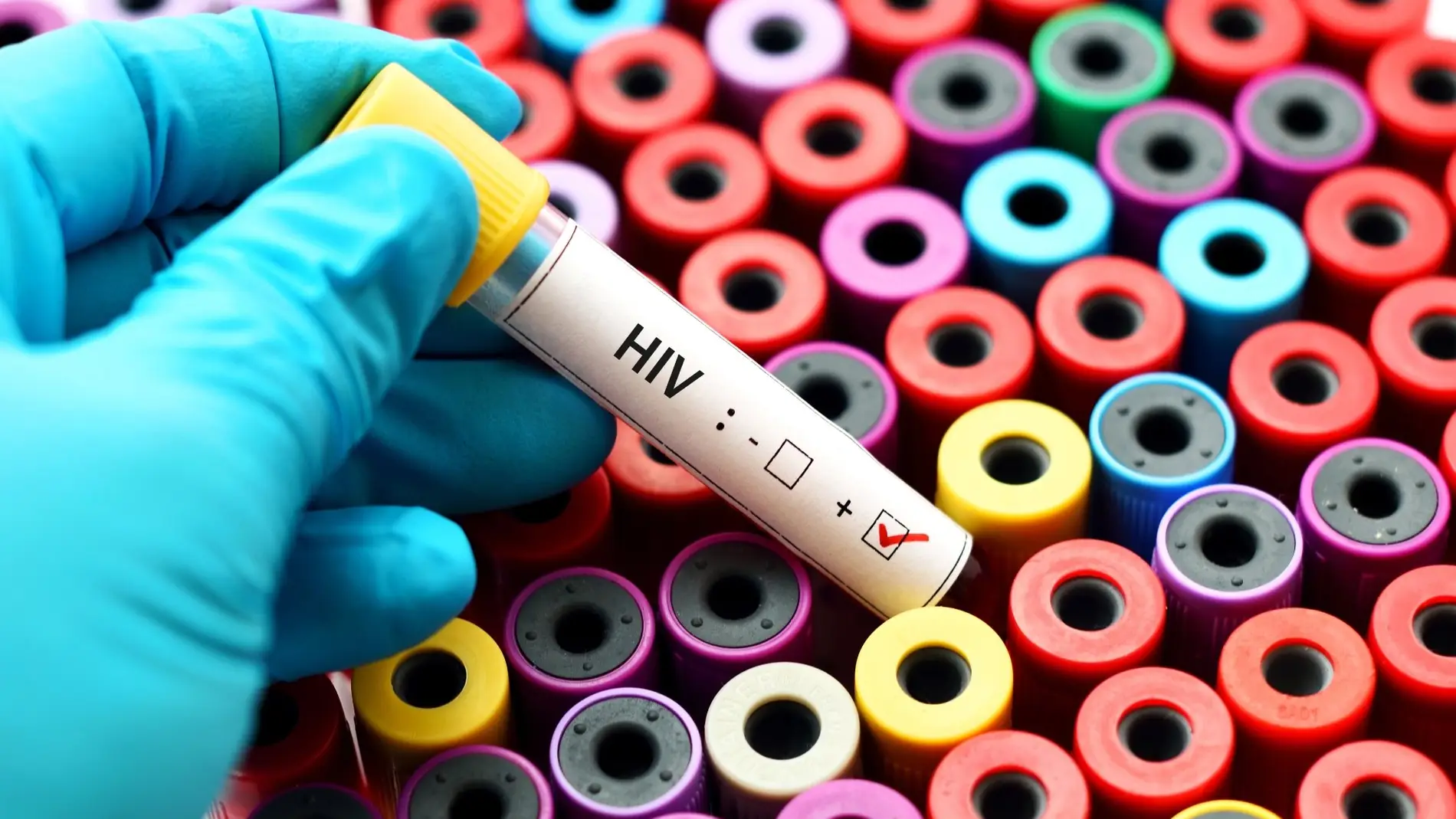 Tercer caso en el mundo de curacion del VIH despues de un trasplante de celulas madre