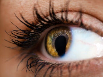 Coloboma de iris en el ojo