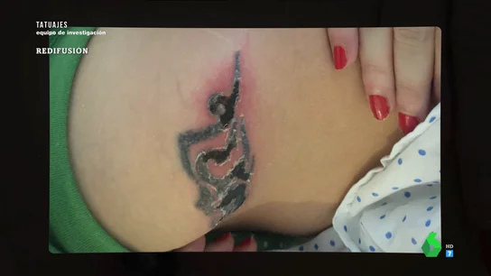 Quemaduras, reacciones alérgicas, infecciones, cicatrices... los riesgos en la eliminación de tatuajes Quemaduras, reacciones alérgicas, infecciones, cicatrices... los riesgos en la eliminación de tatuajes
