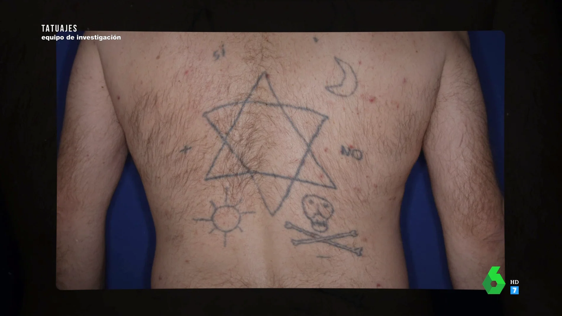 Tatuado por un amigo, en un cementerio, tras una noche de fiesta: el borrado de tatuaje más sorprendente