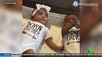 Los gemelos más prematuros del mundo, que nacieron tras 22 semanas de gestación, celebran su primer cumpleaños