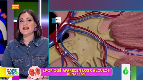 Boticaria García explica por qué aparecen las piedras en el riñón Boticaria García explica por qué aparecen las piedras en el riñón