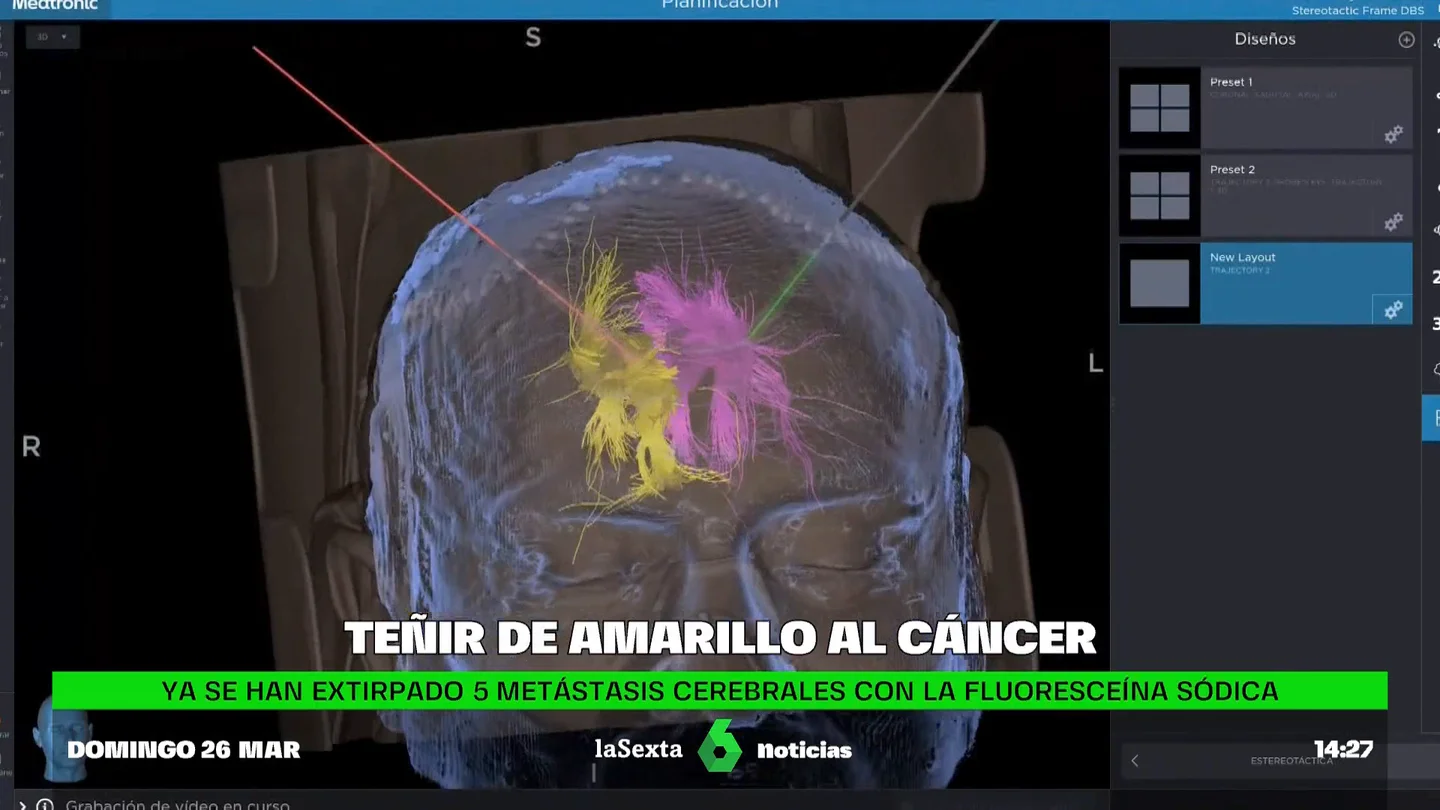 METÁSTASIS METÁSTASIS