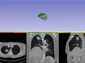 Nuevo biomarcador para predecir el beneficio clínico de la inmunoterapia en pacientes de cáncer de pulmón Nuevo biomarcador para predecir el beneficio clínico de la inmunoterapia en pacientes de cáncer de pulmón