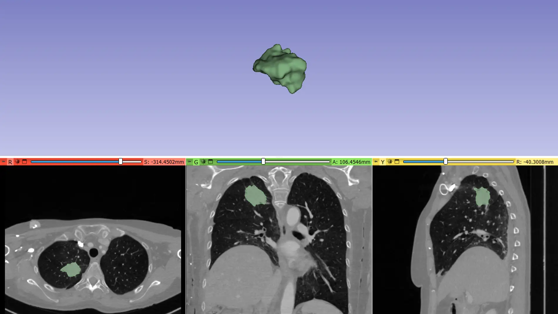Nuevo biomarcador para predecir el beneficio clínico de la inmunoterapia en pacientes de cáncer de pulmón