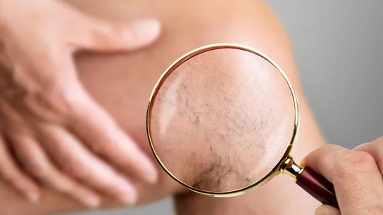 ¿Cómo mejorar los síntomas de las varices y sus complicaciones? Los consejos de los médicos de Atención Primaria ¿Cómo mejorar los síntomas de las varices y sus complicaciones? Los consejos de los médicos de Atención Primaria