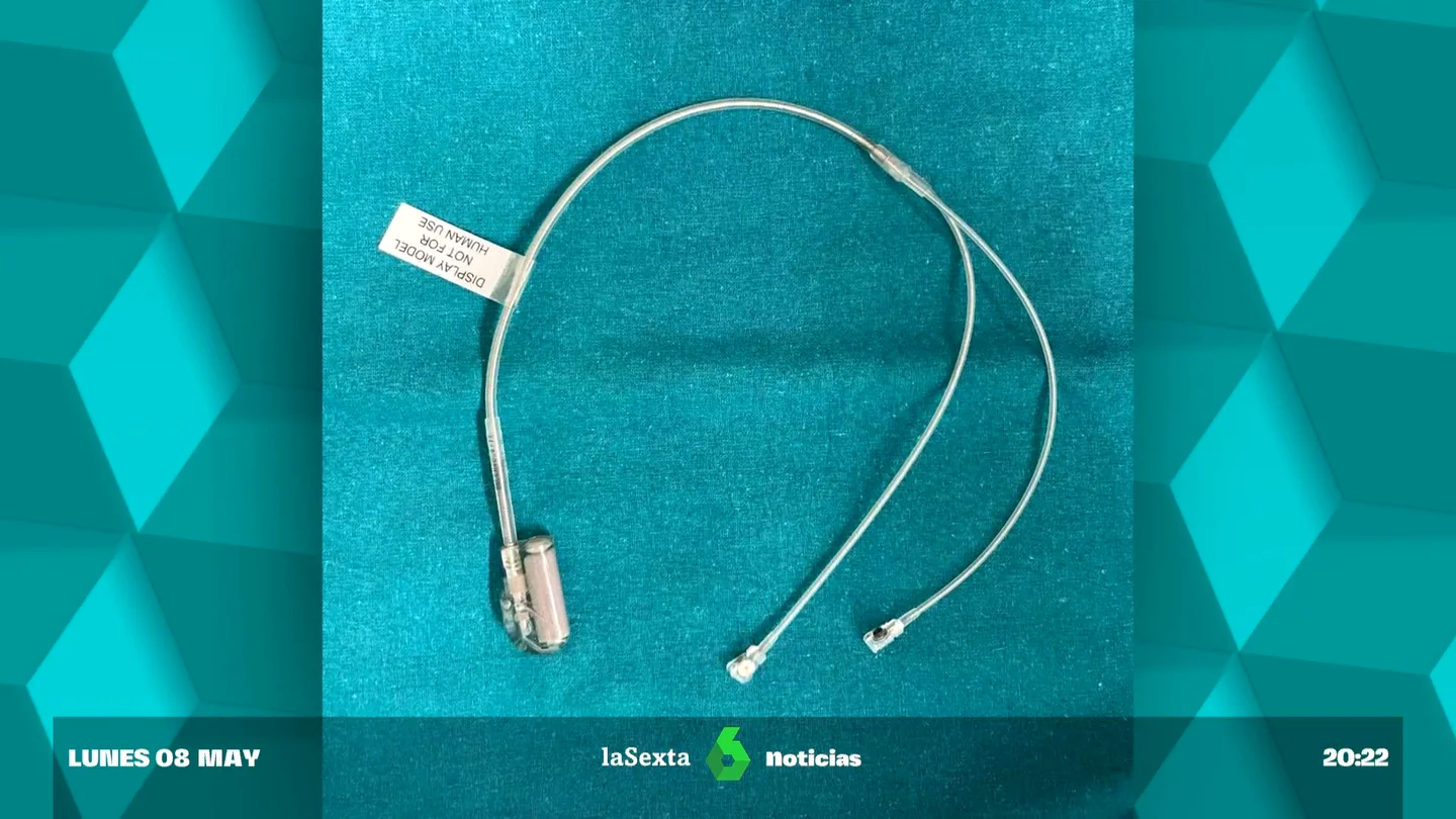 Implantan a un bebé un marcapasos sin cable Implantan a un bebé un marcapasos sin cable
