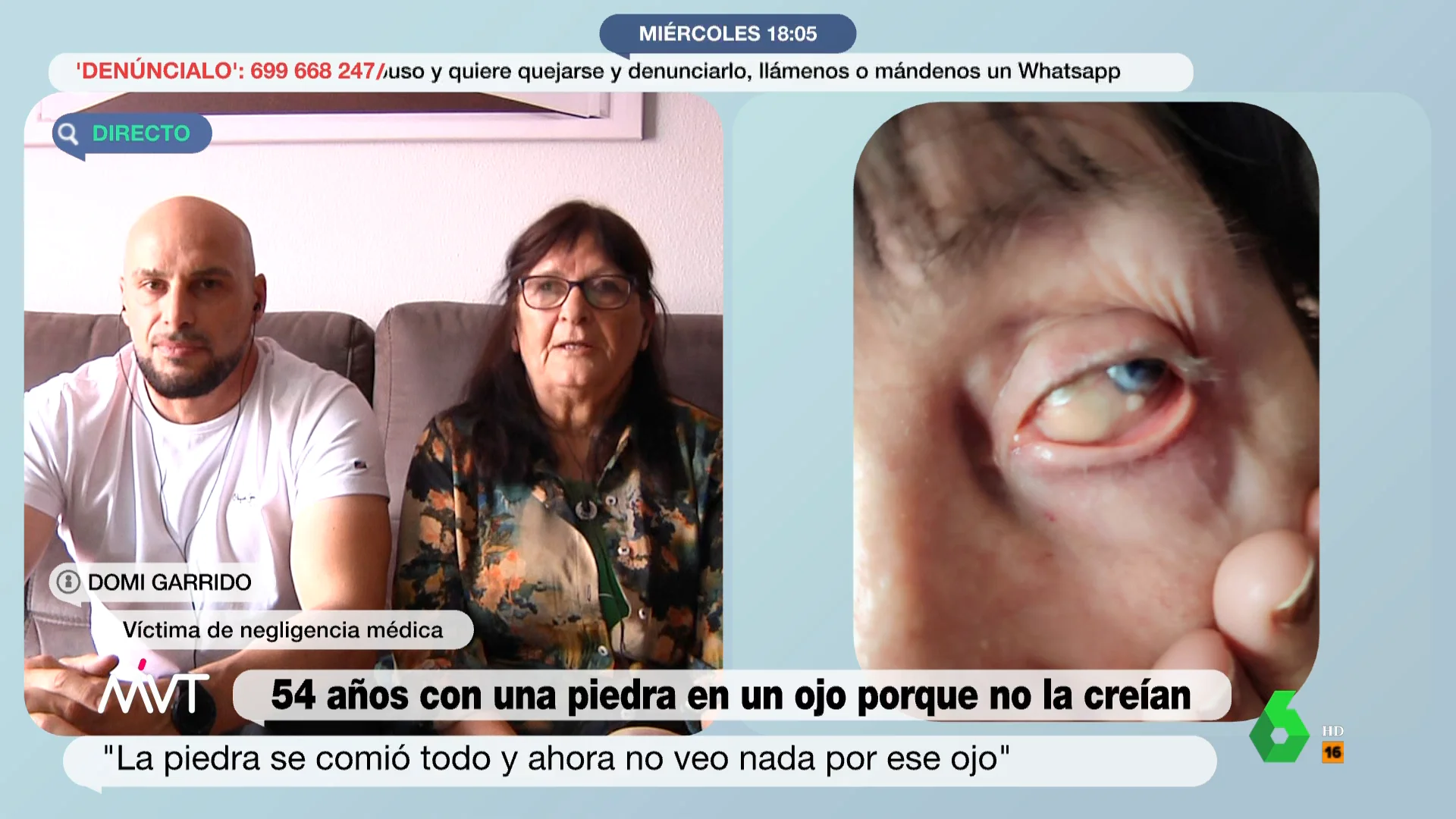 Una mujer pasa 54 años con una piedra dentro del ojo por una negligencia médica