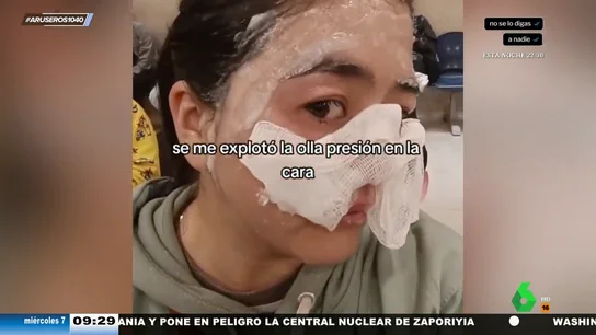 Una joven se quema la mitad de la cara al cocinar lentejas tras explotarle una olla Una joven se quema la mitad de la cara al cocinar lentejas tras explotarle una olla