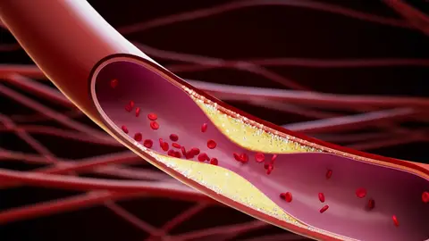 Colesterol Colesterol