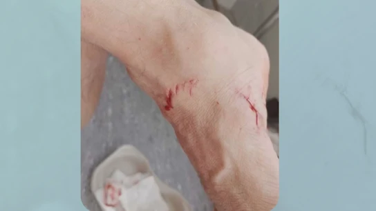 Susto en Oliva por la mordedura de un tiburón azul a un bañista, algo poco habitual: "Da mal rollo" Susto en Oliva por la mordedura de un tiburón azul a un bañista, algo poco habitual: "Da mal rollo"