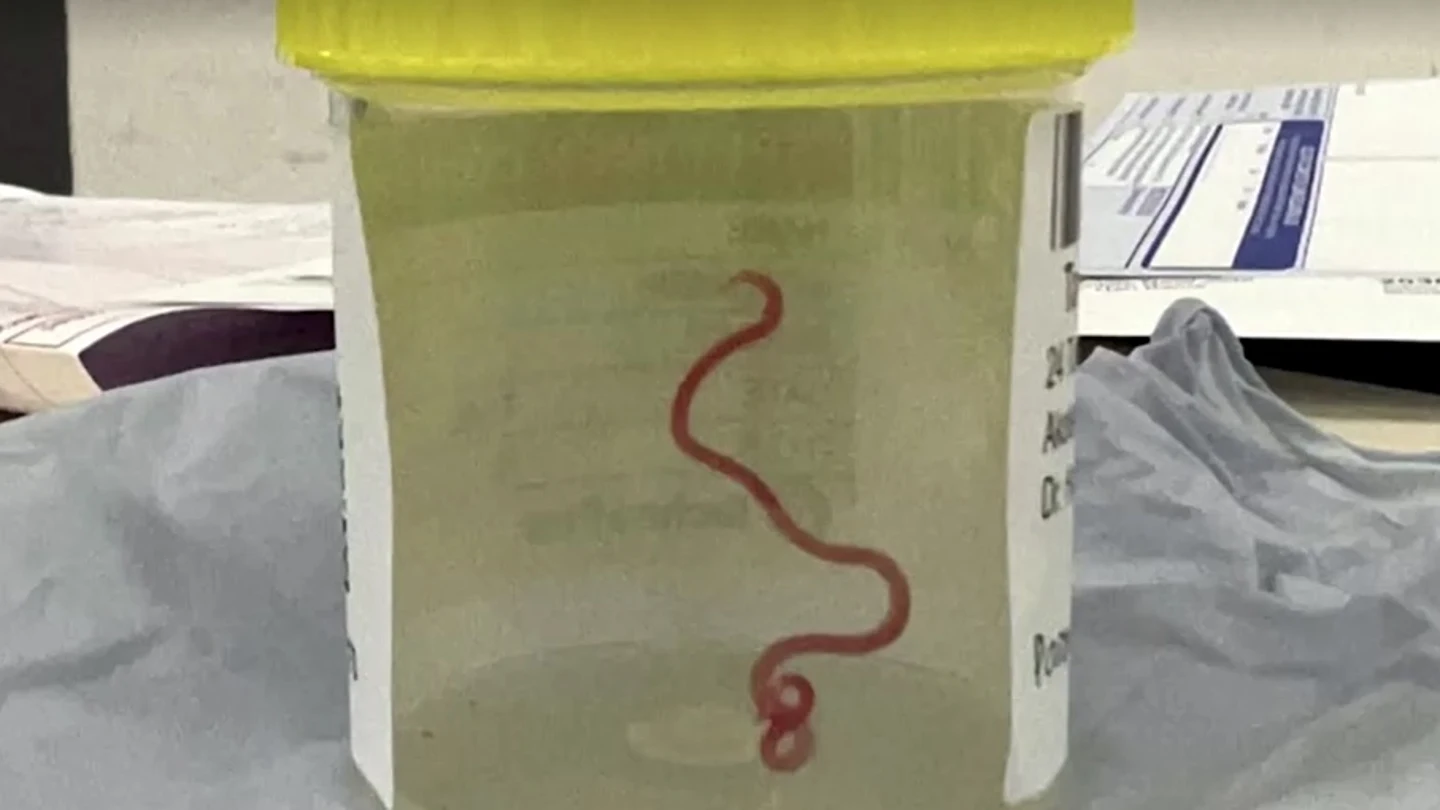 Encuentran un gusano vivo de 8 cm en el celebro de una mujer en Autralia. Encuentran un gusano vivo de 8 cm en el celebro de una mujer en Autralia.