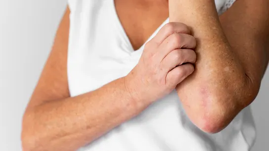 Imagen de archivo de una persona rascándose la piel. Imagen de archivo de una persona rascándose la piel.