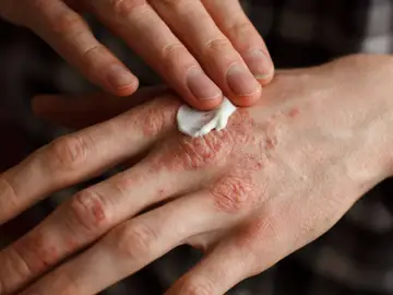 Psoriasis Psoriasis
