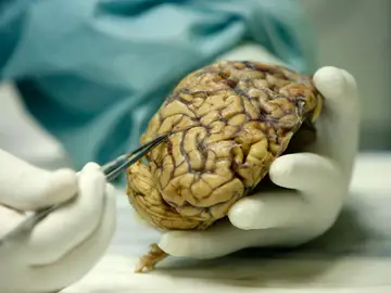 2023: un año de esperanza contra el Alzheimer 2023: un año de esperanza contra el Alzheimer