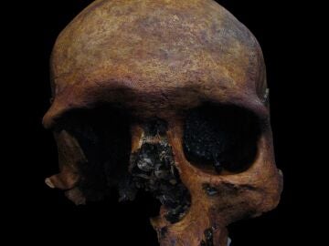 Detectado un caso de tumor craneal de epoca romana en la peninsula iberica