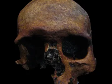 Detectado un caso de tumor craneal de epoca romana en la peninsula iberica Detectado un caso de tumor craneal de epoca romana en la peninsula iberica