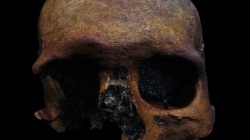 Detectado un caso de tumor craneal de epoca romana en la peninsula iberica