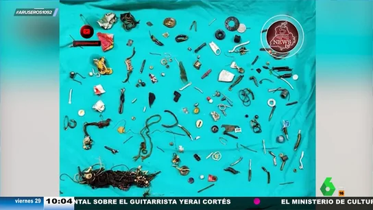 Extraen tornillos, auriculares, medallas y otros objetos del estómago de un hombre: "Hay algo que le ha sentado mal" Extraen tornillos, auriculares, medallas y otros objetos del estómago de un hombre: "Hay algo que le ha sentado mal"