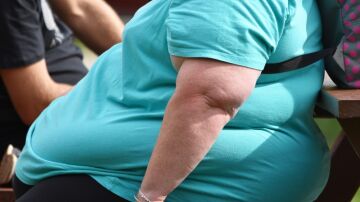 Empatía y humanización para combatir la gordofobia: "Los pacientes no escogen la obesidad"