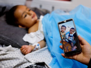The story of the twins Wateen and Ahmad, the babies separated by an Israeli attack in which their mother died