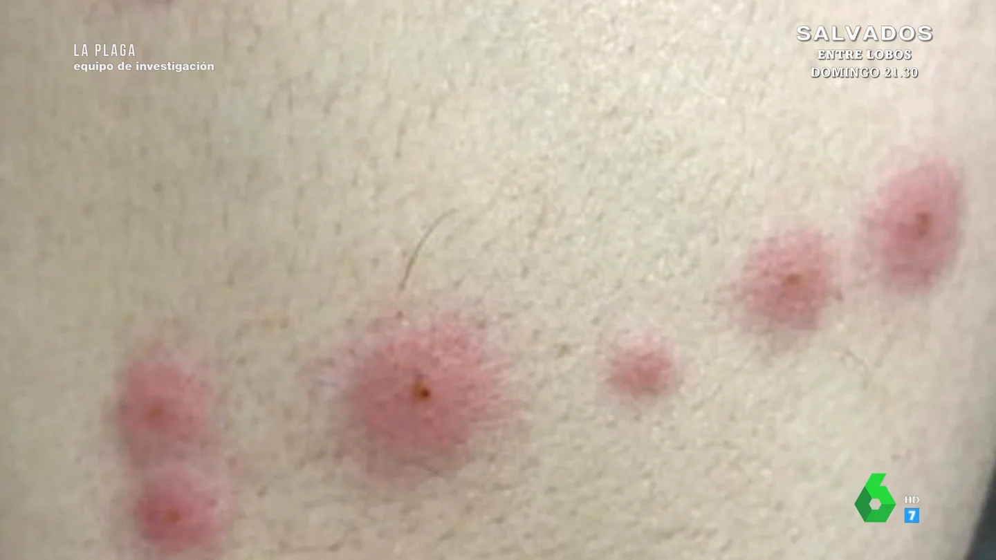 ¿Cómo reconocer una picadura de chinche? Una dermatóloga de las claves en Equipo de Investigación ¿Cómo reconocer una picadura de chinche? Una dermatóloga de las claves en Equipo de Investigación