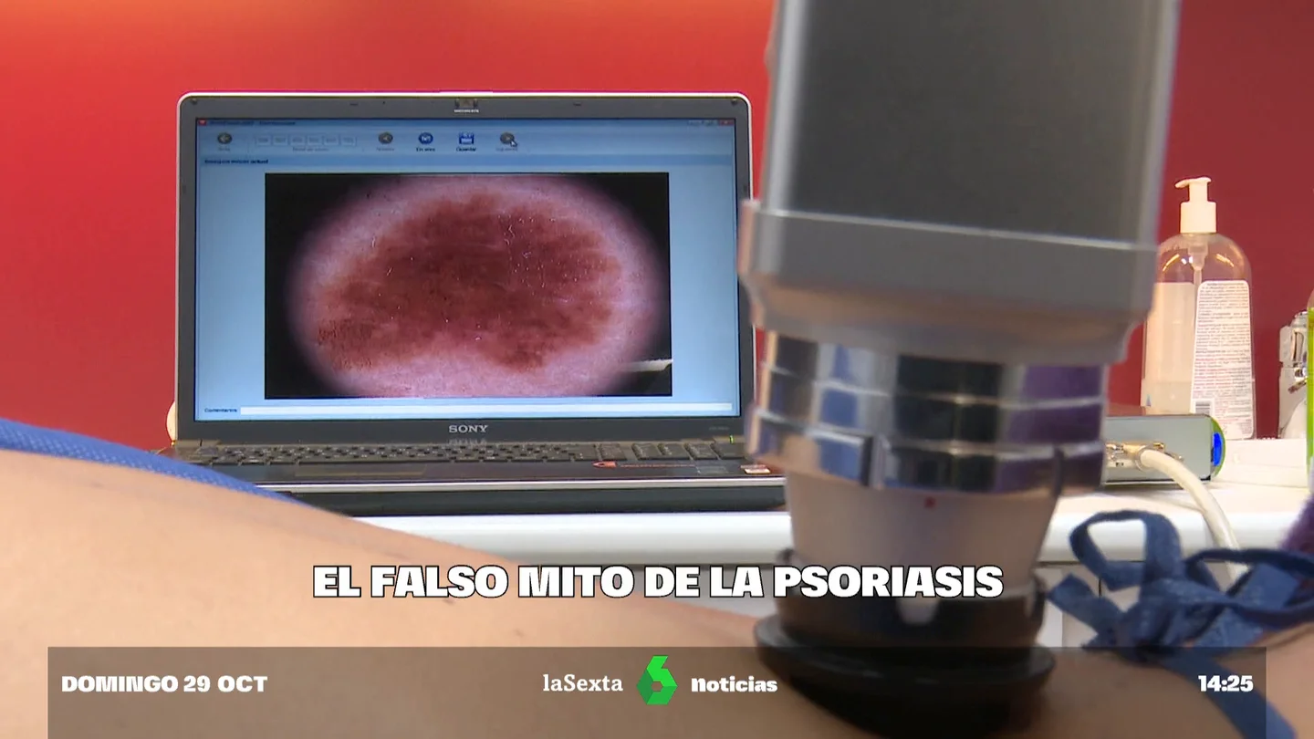 PSORIASIS PSORIASIS