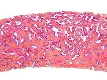 Micrografía de próstata Micrografía de próstata