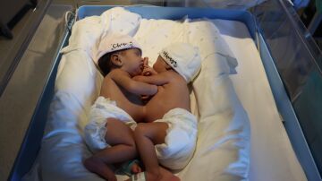 El Hospital Sant Joan de Déu "separa" con éxito a unas gemelas siamesas que nacieron unidas por la parte superior del abdomen