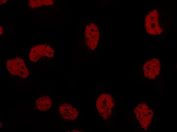 Tinción nuclear de células de cáncer de mama triple negativo Tinción nuclear de células de cáncer de mama triple negativo
