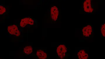 Tinción nuclear de células de cáncer de mama triple negativo Tinción nuclear de células de cáncer de mama triple negativo