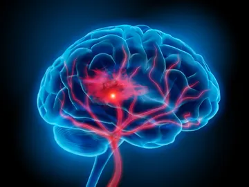 accidente cerebrovascular accidente cerebrovascular