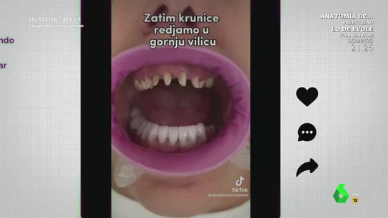 Un odontólogo advierte sobre los riesgos en la "moda" de sustituir los dientes por coronas: "Es una locura" Un odontólogo advierte sobre los riesgos en la "moda" de sustituir los dientes por coronas: "Es una locura"
