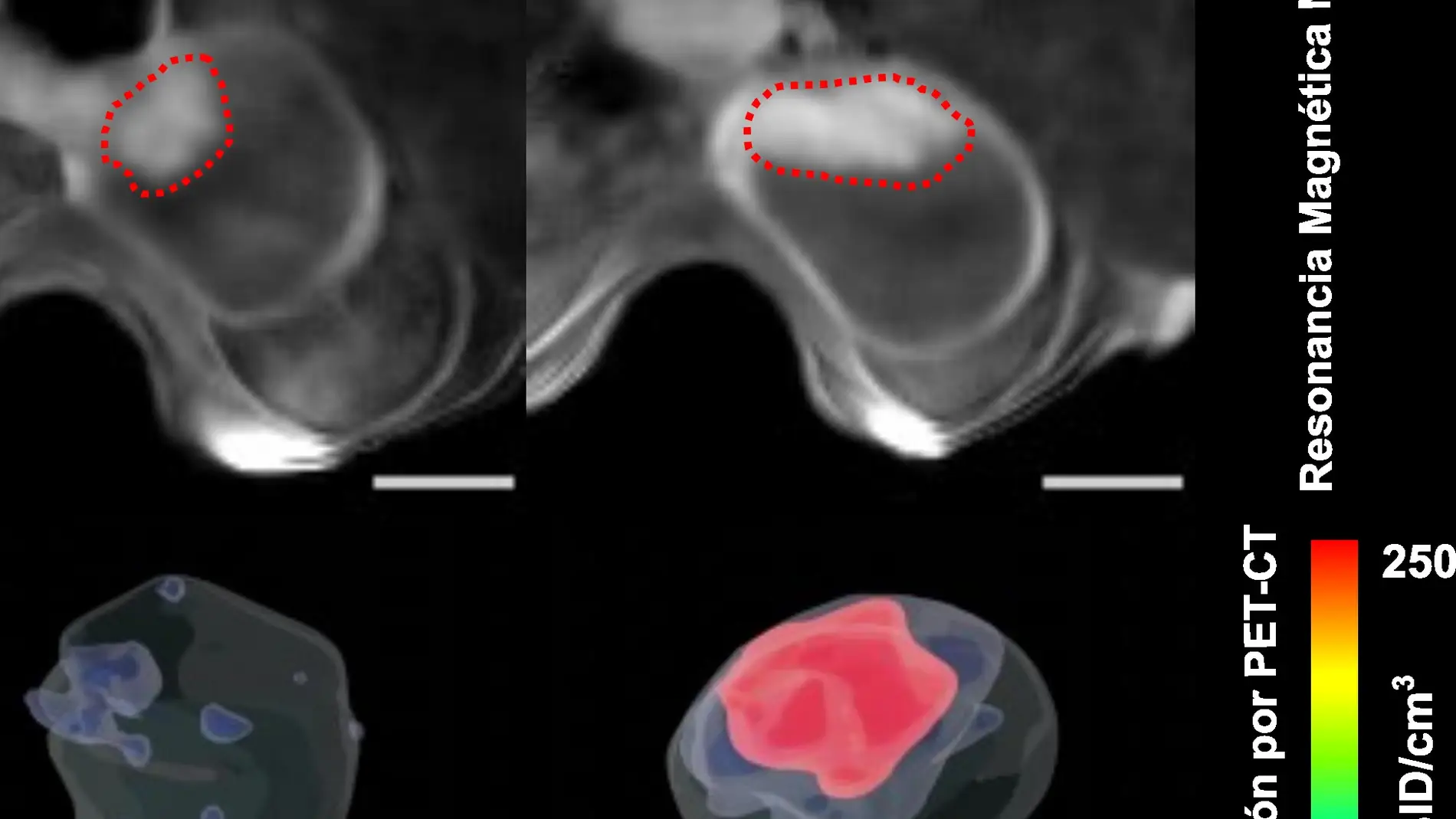 Los tumores de vejiga se reducen en un 90 con el uso de nanorrobots