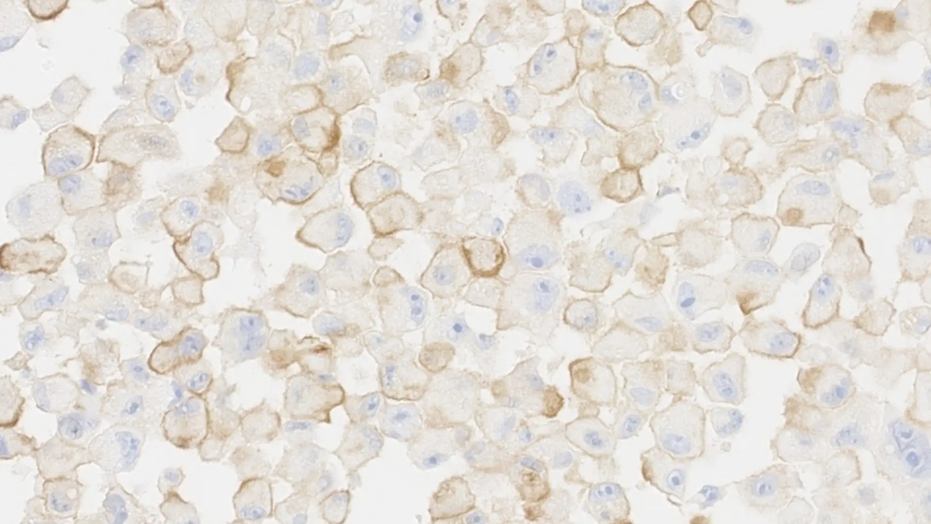 Células tumorales senescentes de melanoma humano