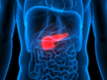 Cáncer de páncreas Cáncer de páncreas