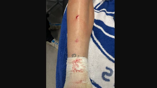 Así quedó la pierna de Rafa Marín ante el Barça Así quedó la pierna de Rafa Marín ante el Barça