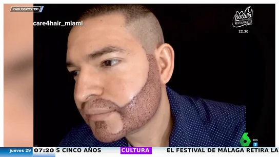 El surrealista anuncio de un implante de barba con resultado un tanto dudoso: "¿Esto es publicidad o denuncia?" El surrealista anuncio de un implante de barba con resultado un tanto dudoso: "¿Esto es publicidad o denuncia?"