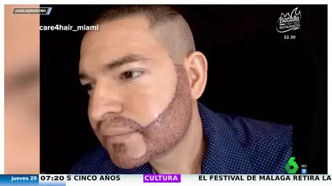 El surrealista anuncio de un implante de barba con resultado un tanto dudoso: "¿Esto es publicidad o denuncia?"