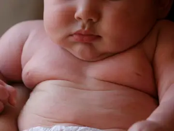 Obesidad infantil Obesidad infantil